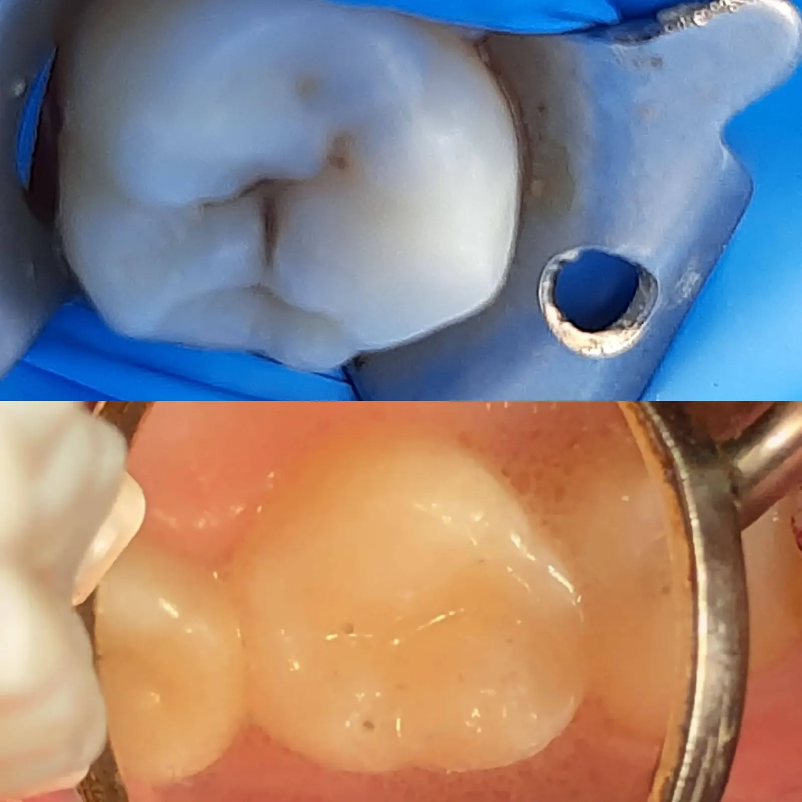 Resina dental